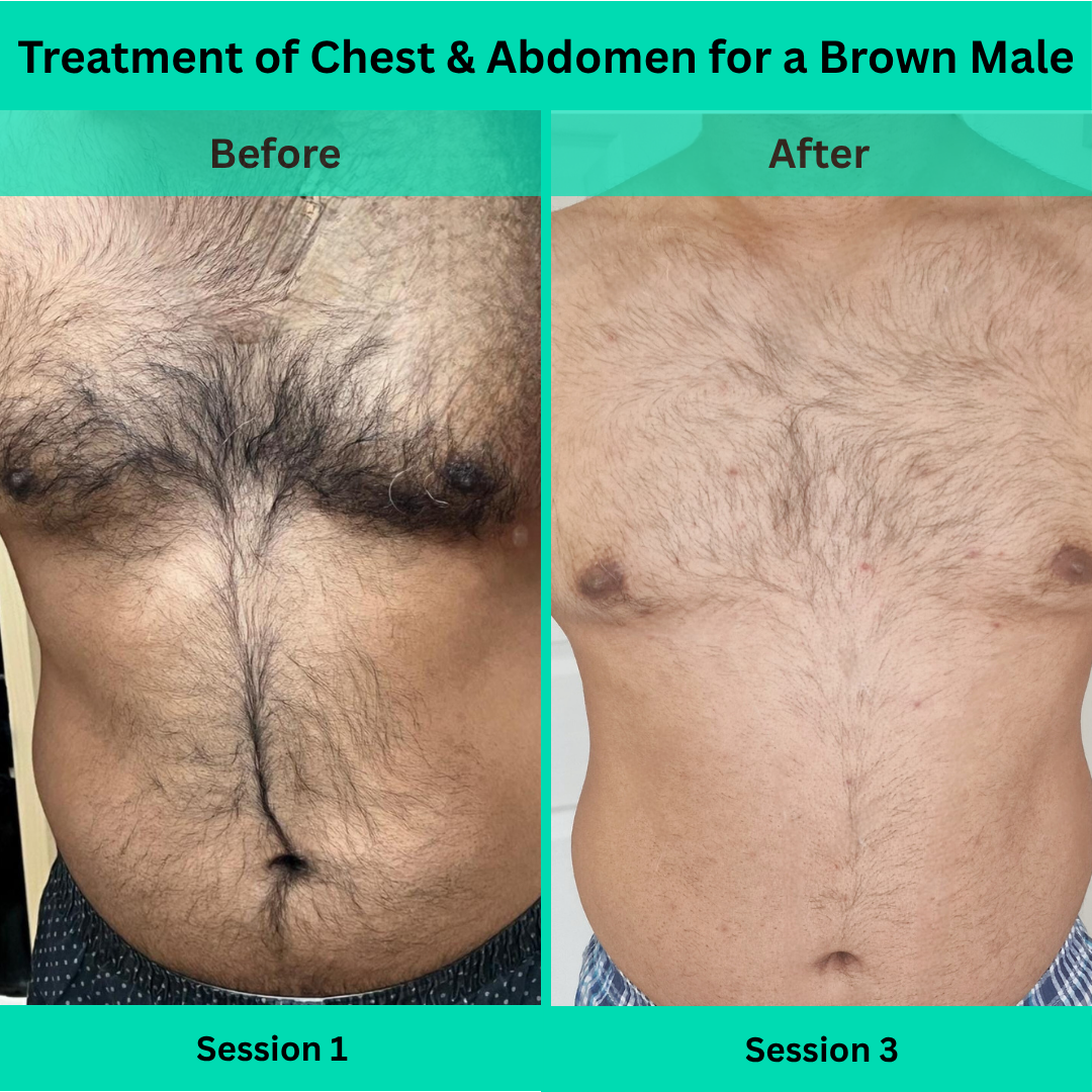 Before and After picture of Laser Hair Removal Treatment of Chest Abdomen for a Brown Male